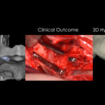 3D Planned, Guided Quad Zygomatic Implant Placement with hybridized 3D post op imaging. This surgery video finishes with a visual comparison between 3D treatment plan, clinical outcome and post op image to demonstrate the efficacy of this new Guided Zygomatic Implant protocol. I planned the implant paths and positions in 3D treatment planning space based on 3D representation of the patient anatomy in the form of the segmented DICOM file. This precision-optimized plan is the basis for a new guide design which transfers all of the quantified variables in the 3D plan directly to the patient, intraoperatively.