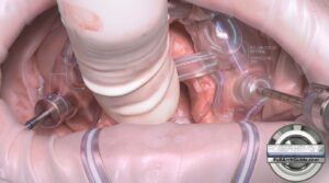 Guided Pterygoid Implant Success 80ncm/80ncm