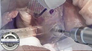 Guided Pterygoid Implant Case - Rescuing a Failed All on X