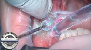 Guided Pterygoid Implant Success! R-35Ncm/L-80Ncm