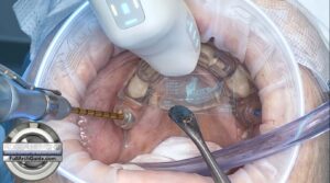Guided Pterygoid Implant - Quad Zygo Avoided