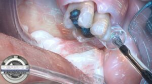 Surgery Video of 3D Planned and Guided Pterygoid Implant Placement for Remote Anchorage