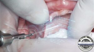 Guided Pterygoid Implant Placement