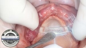 Pterygoid Full Arch Implant Guide Stability